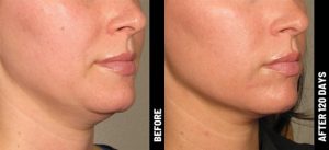 Ultherapy (Ultrasound Lift)